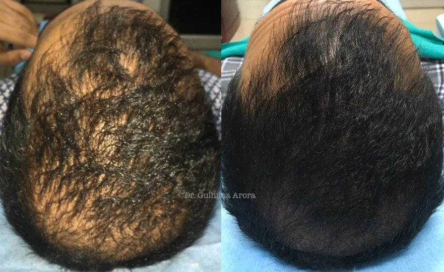 Get Rid of Acne Scars: Prevention and Treatment Options for Healthy Skin