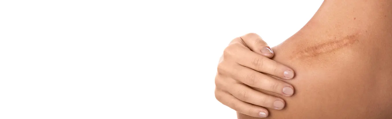 Scars and Treatments