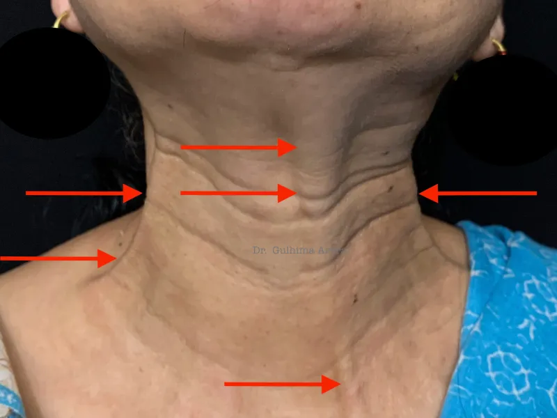 How to Get Sagging Neck Treated With Botulinum Toxin