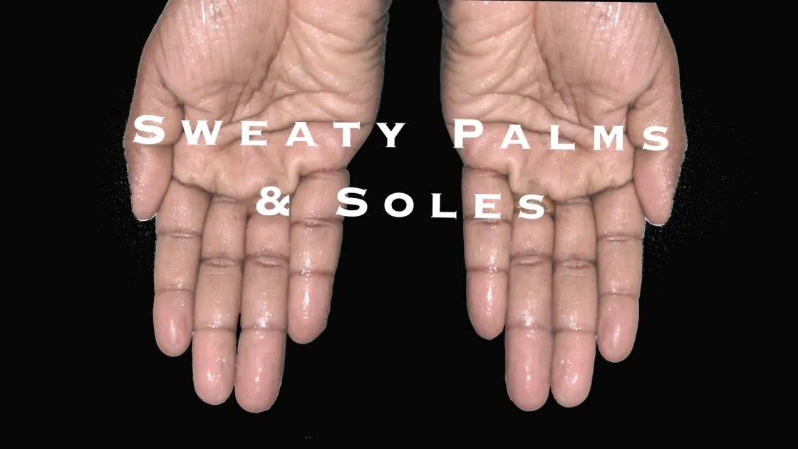 Want To Treat Sweaty Palms And Soles?