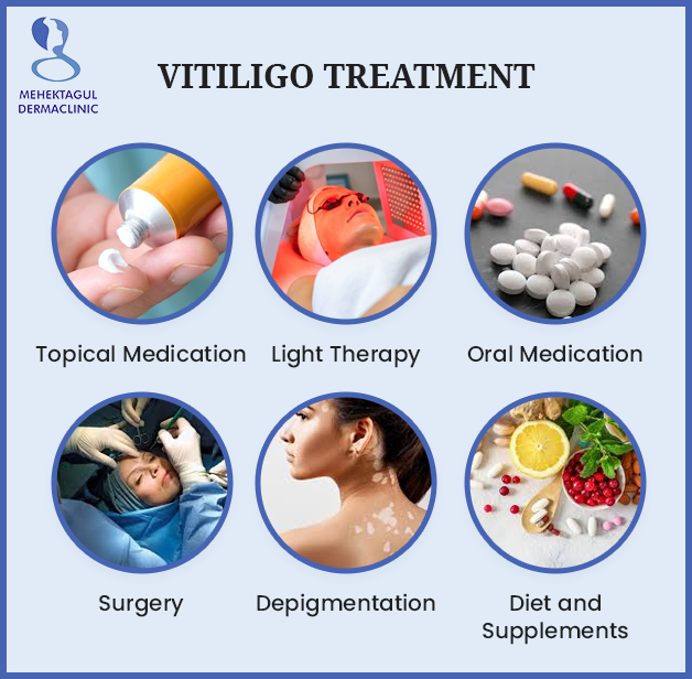 Vitiligo treatment in Delhi: A few treatment for vitiligo including Topical Medication, Light Therapy, Oral Medication, and etc. 