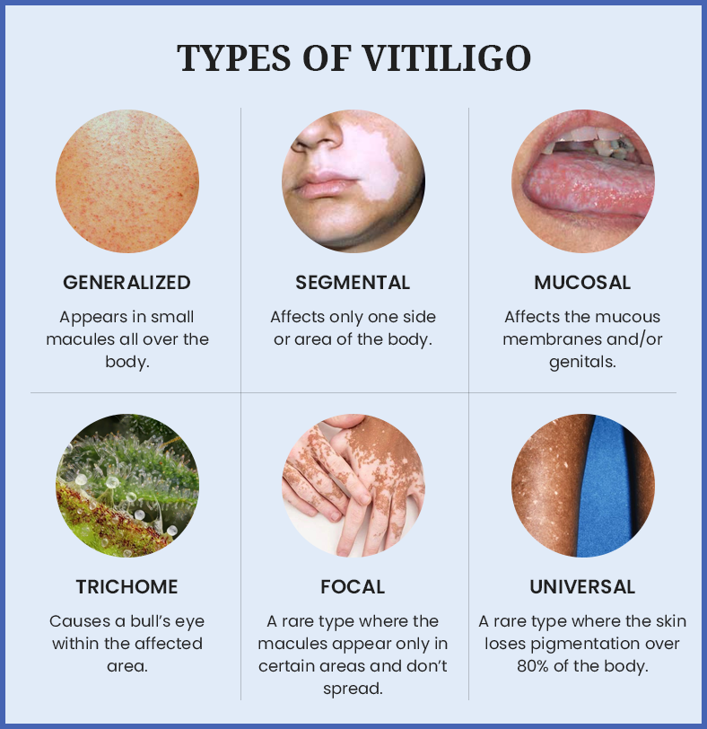 Vitiligo treatment in Delhi: A few common types of Vitiligo like Generalized, Segmental, Mucosal, Trichome, Focal, and Universal.