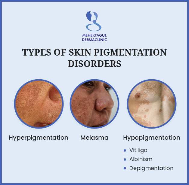  Pigmentation treatment in Delhi: Three types of Skin Pigmentation Disorders, Hyperpigmentation, Melasma, and Hypopigmentation.