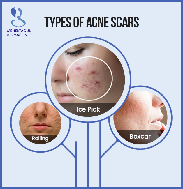 acne scar treatment in Delhi: Acne scars are of two major types: depressed scars and raised scars.